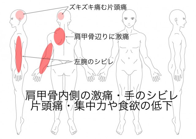 胸郭出口症候群（國枝）