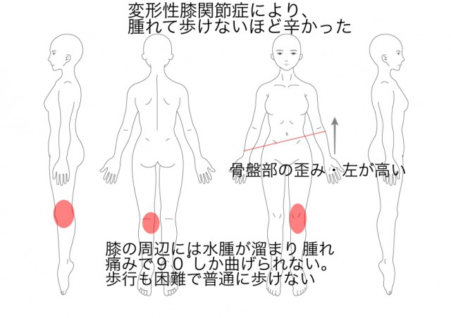 変形性膝関節症（西川裕子）