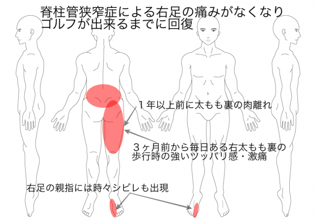 脊柱管狭窄症：安田澄雄