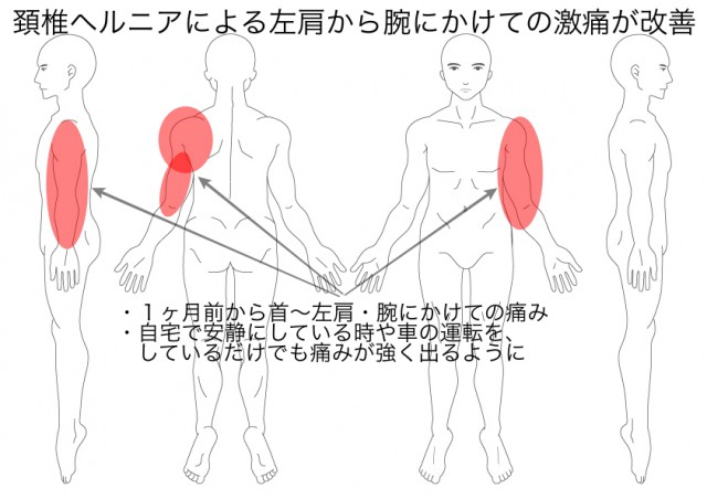 頚椎ヘルニア（広瀬）