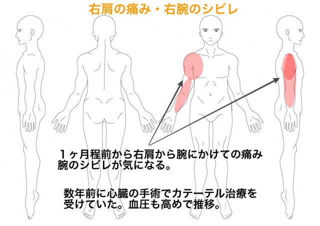 右肩から腕にかけての痛み 腕のシビレが良くなり ゴルフや登山へも行けそうです 岐阜県瑞穂市の整体 みつむら接骨院 岐阜 坐骨神経痛で有名 みつむら接骨院