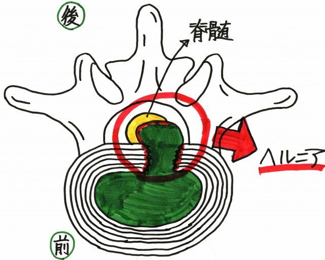 ヘルニア画像１