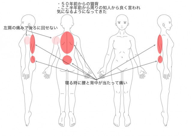 猫背（その１）