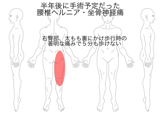 腰椎ヘルニア・狭窄症・坐骨神経痛（駒田）