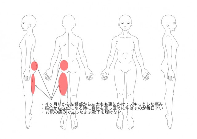 坐骨神経痛（その１）