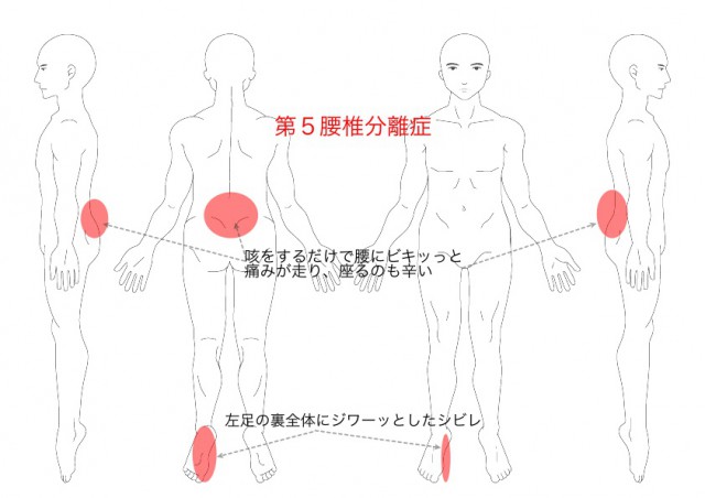 分離症（その１）