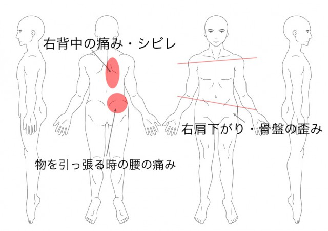 骨盤矯正（駒月啓汰）