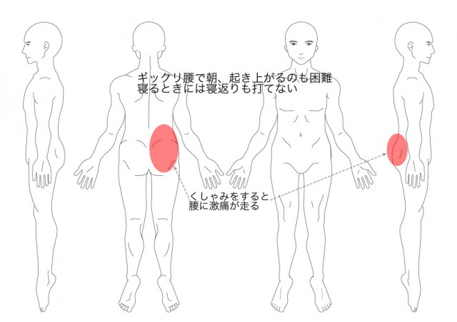 ぎっくり腰（その２）