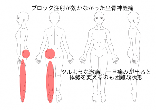 坐骨神経痛