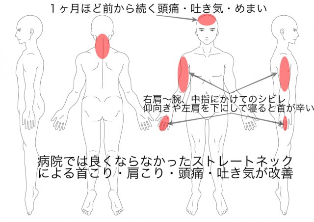 ストレートネック・頭痛・吐き気（池戸猛）
