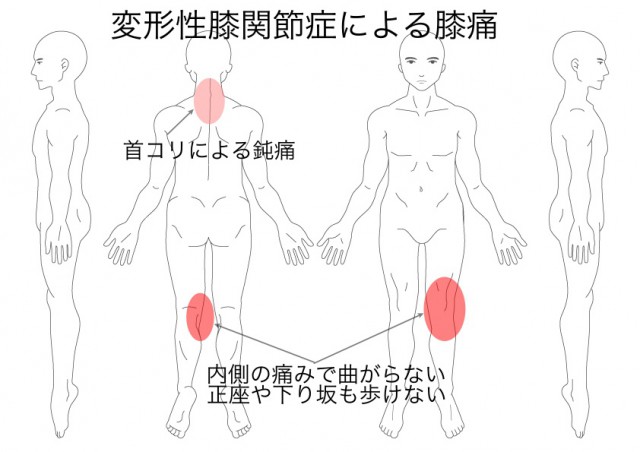 変形性膝関節症（中谷新一）